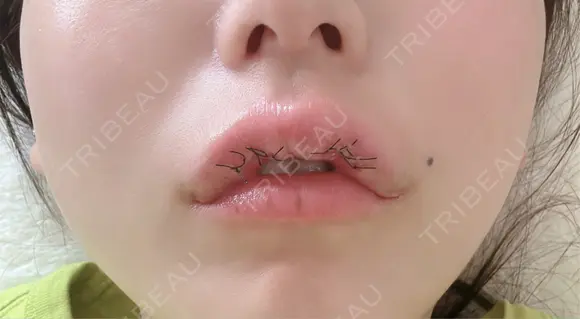 その他（口元） アネシス美容クリニック DAY 5 メイン用