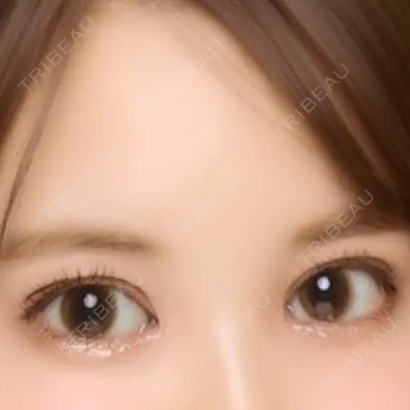 二重切開 / 目頭切開 / 眼瞼下垂（切開） / その他（目元） / 上まぶたの脂肪取り レアート整形外科 DAY 29 メイン用