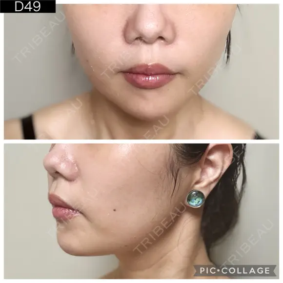糸リフト PRISM Beauty Clinic 町田院 DAY 49 メイン用