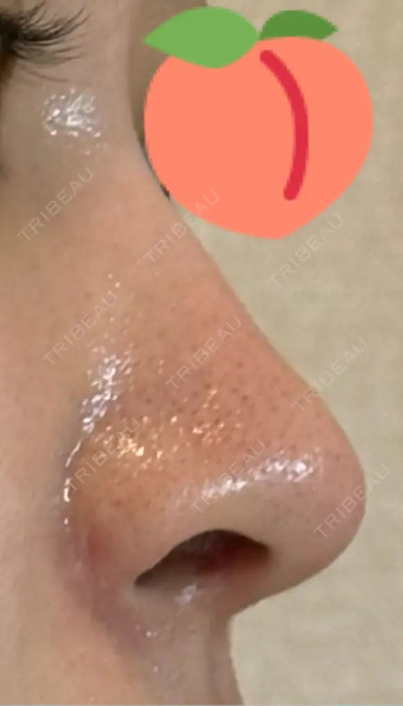 鼻尖形成（切開） / 骨削り（頬） / 軟骨移植 / 鼻孔縁挙上 THE ROPPONGI CLINIC（ザ 六本木クリニック） DAY 91 メイン用