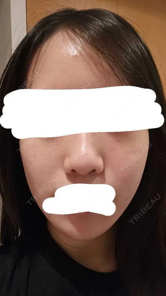 水光注射（ハリ・美肌） RAISE CLINIC 【レイズクリニック】 DAY 1 メイン用