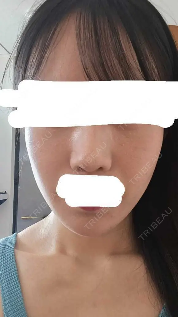 水光注射（ハリ・美肌） RAISE CLINIC 【レイズクリニック】 DAY 1 メイン用