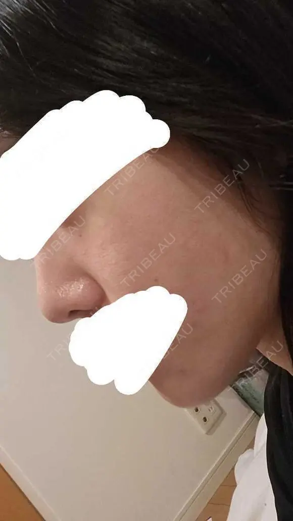 水光注射（ハリ・美肌） RAISE CLINIC 【レイズクリニック】 DAY 1 メイン用