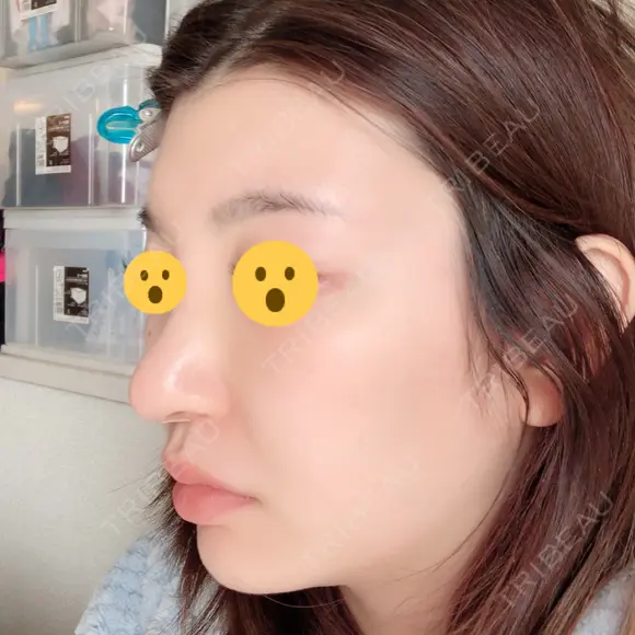 鼻尖形成（切開） / 鼻中隔延長（切開） / 脂肪溶解注射 / ボトックス（肩） / その他（鼻） エートップ美容整形外科 DAY 10 メイン用
