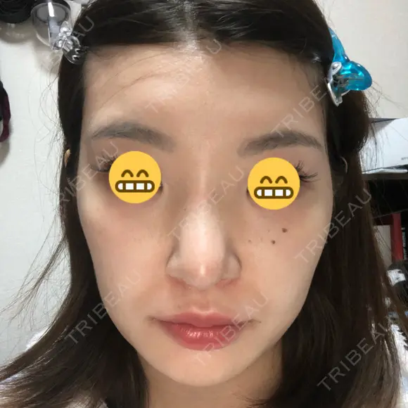 鼻尖形成（切開） / 鼻中隔延長（切開） / 脂肪溶解注射 / ボトックス（肩） / その他（鼻） エートップ美容整形外科 DAY 11 メイン用