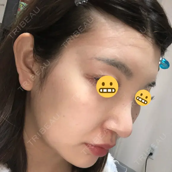 鼻尖形成（切開） / 鼻中隔延長（切開） / 脂肪溶解注射 / ボトックス（肩） / その他（鼻） エートップ美容整形外科 DAY 11 メイン用