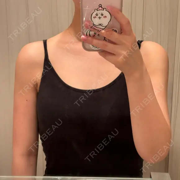 脂肪吸引（二の腕） 湘南美容クリニック 京都院 DAY 21 メイン用