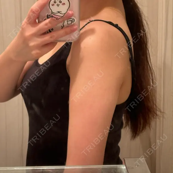 脂肪吸引（二の腕） 湘南美容クリニック 京都院 DAY 21 メイン用