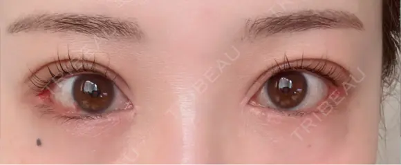 タレ目形成・グラマラスライン（切開） アネシス美容クリニック DAY 6 メイン用