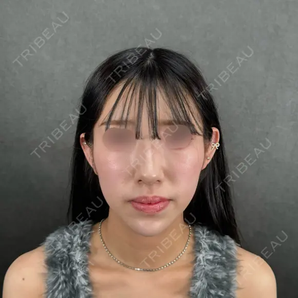 二重埋没 / 目頭切開 / 糸リフト / 脂肪吸引（顔） / ヒアルロン酸注入（涙袋） / ヒアルロン酸注入（あご） / ボトックス（エラ・小顔） / ボトックス（人中） ネビュラクリニック 京都院 AFTER メイン用