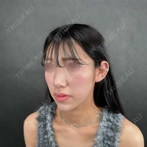 二重埋没 / 目頭切開 / 糸リフト / 脂肪吸引（顔） / ヒアルロン酸注入（涙袋） / ヒアルロン酸注入（あご） / ボトックス（エラ・小顔） / ボトックス（人中） ネビュラクリニック 京都院 DAY 0 メイン用