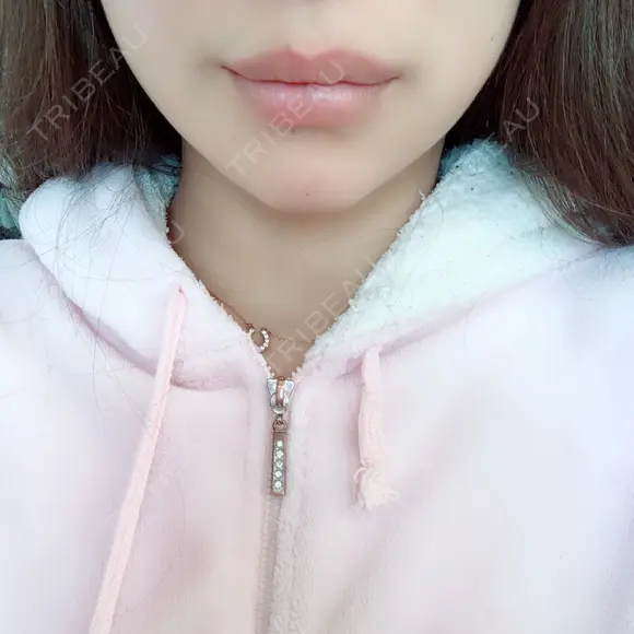 骨切り（あご） / 輪郭修正 / 脂肪溶解注射（顔） 心斎橋コムロ美容外科クリニック DAY 101 メイン用