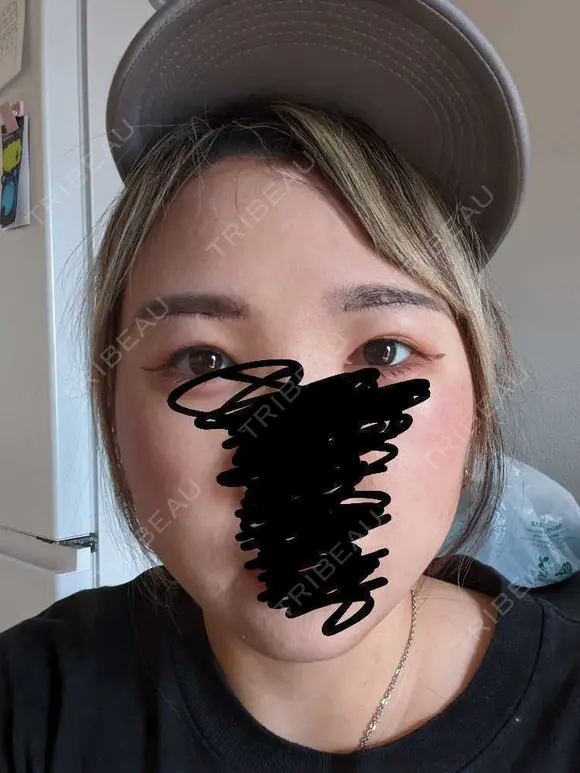 上まぶたたるみ取り / ダーマペン / 毛穴洗浄（ハイドラフェイシャルなど） Leap beauty clinic DAY 2 メイン用