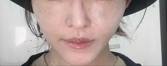 クマ治療 WOM CLINIC GINZA （ワム クリニック ギンザ） DAY 2 メイン用