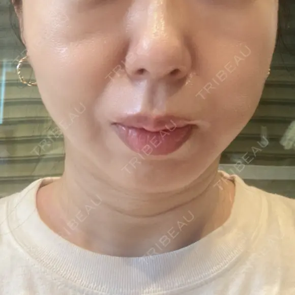 糸リフト BAO CLINIC 梅田院 DAY 8 メイン用