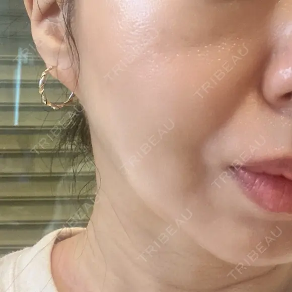 糸リフト BAO CLINIC 梅田院 DAY 8 メイン用