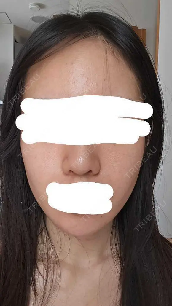 水光注射（ハリ・美肌） RAISE CLINIC 【レイズクリニック】 DAY 2 メイン用