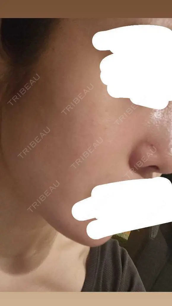 水光注射（ハリ・美肌） RAISE CLINIC 【レイズクリニック】 DAY 3 メイン用