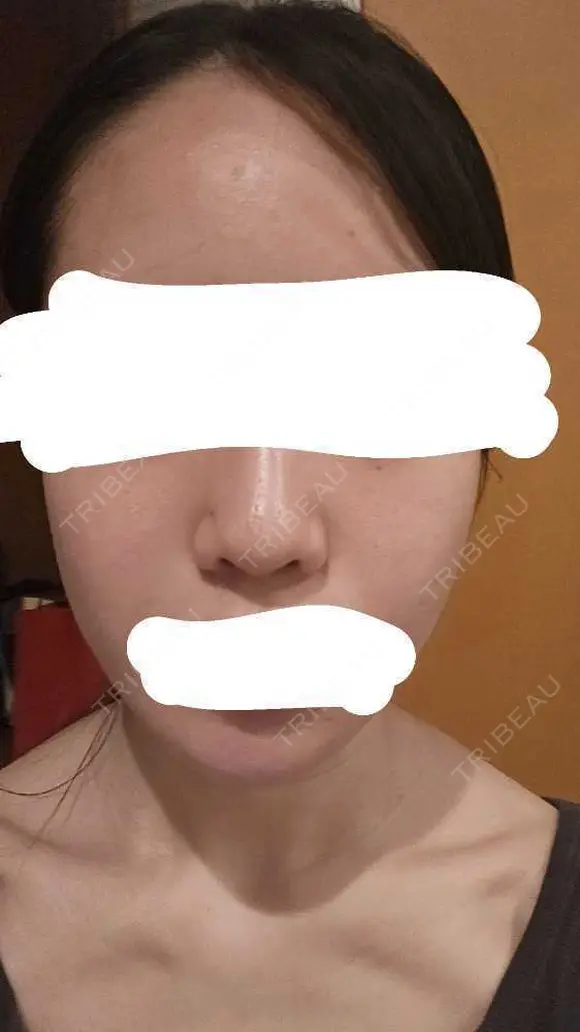 水光注射（ハリ・美肌） RAISE CLINIC 【レイズクリニック】 DAY 3 メイン用