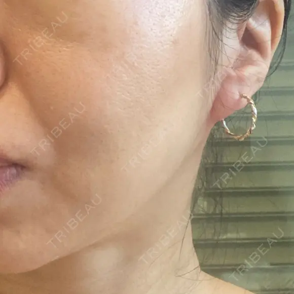 糸リフト BAO CLINIC 梅田院 DAY 9 メイン用