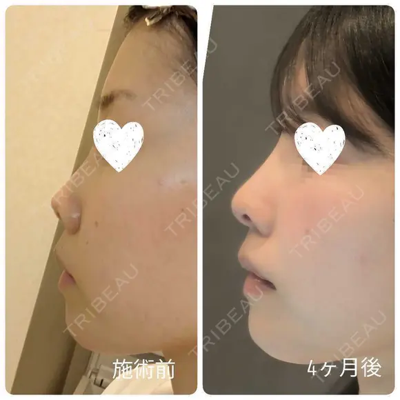 隆鼻術 / 鼻尖形成（切開） / 小鼻縮小（切開） / 軟骨移植 / 鼻柱下降・鼻唇角形成（猫手術） / ボトックス（エラ・小顔） / 毛穴洗浄（ハイドラフェイシャルなど） グローバルビューティークリニック 大阪院 DAY 119 メイン用