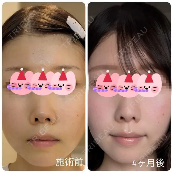 隆鼻術 / 鼻尖形成（切開） / 小鼻縮小（切開） / 軟骨移植 / 鼻柱下降・鼻唇角形成（猫手術） / ボトックス（エラ・小顔） / 毛穴洗浄（ハイドラフェイシャルなど） グローバルビューティークリニック 大阪院 DAY 119 メイン用