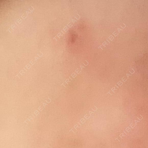 ほくろ・いぼ切除（肌） Belle Via Skin Clinic DAY 8 メイン用