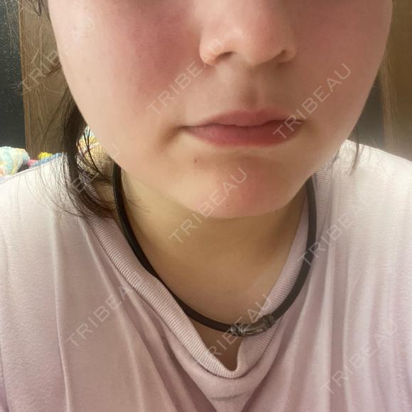 ほくろ・いぼ切除（肌） Belle Via Skin Clinic DAY 8 メイン用