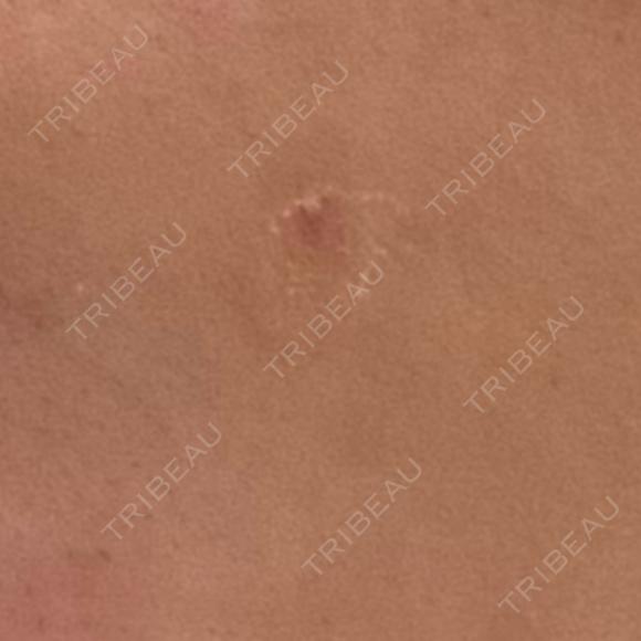 ほくろ・いぼ切除（肌） Belle Via Skin Clinic AFTER メイン用