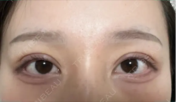 二重埋没 BELINDA CLINIC（ベリンダクリニック）新宿院 DAY 24 メイン用