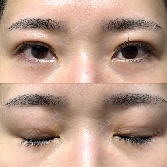 二重埋没 / クマ治療 / 上まぶたの脂肪取り / 下まぶたの脂肪取り NARU Beauty Clinic 【ナルクリ】 DAY 29 メイン用
