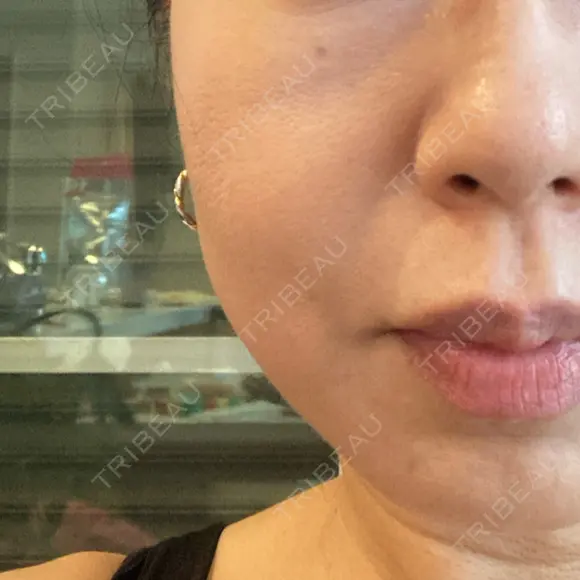 糸リフト BAO CLINIC 梅田院 DAY 10 メイン用