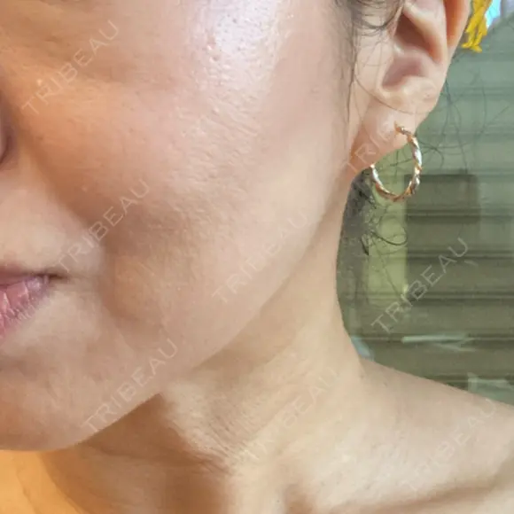 糸リフト BAO CLINIC 梅田院 DAY 10 メイン用