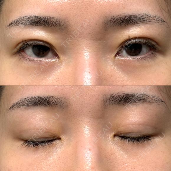 二重埋没 / クマ治療 / 上まぶたの脂肪取り / 下まぶたの脂肪取り NARU Beauty Clinic 【ナルクリ】 DAY 30 メイン用