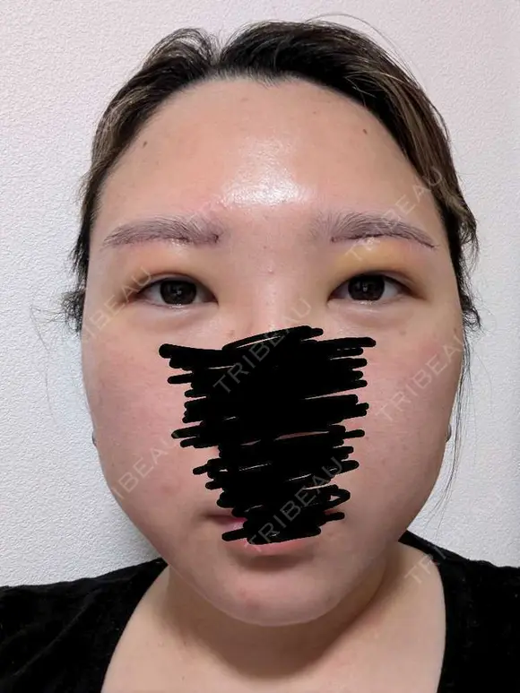 上まぶたたるみ取り / ダーマペン / 毛穴洗浄（ハイドラフェイシャルなど） Leap beauty clinic DAY 4 メイン用