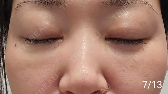 スネコス REVO CLINIC PLUS DAY 7 メイン用