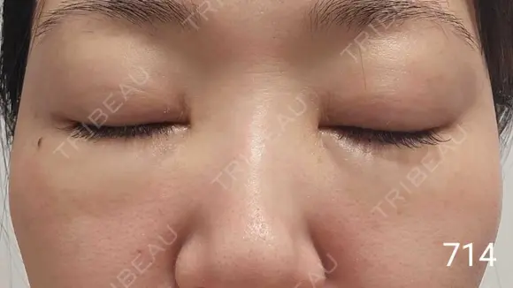 スネコス REVO CLINIC PLUS DAY 8 メイン用