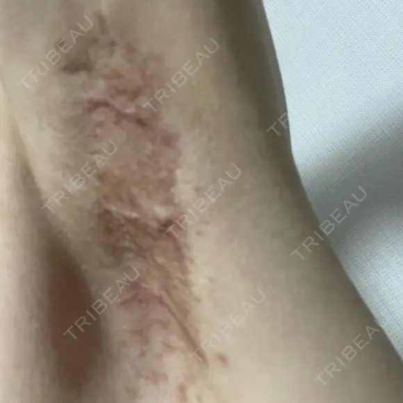 ワキ汗治療（切開） 石倉クリニック 水戸院 DAY 63 メイン用