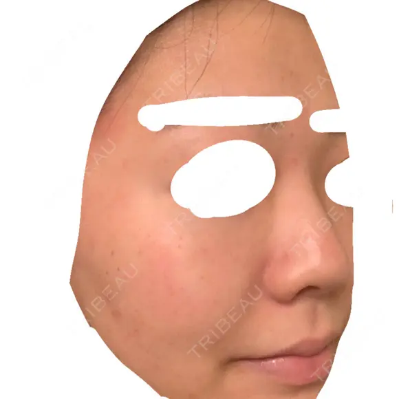 フラクショナルレーザー（毛穴・ニキビ跡） しらゆりメディカルクリニック （旧しらゆりビューティークリニック） AFTER メイン用