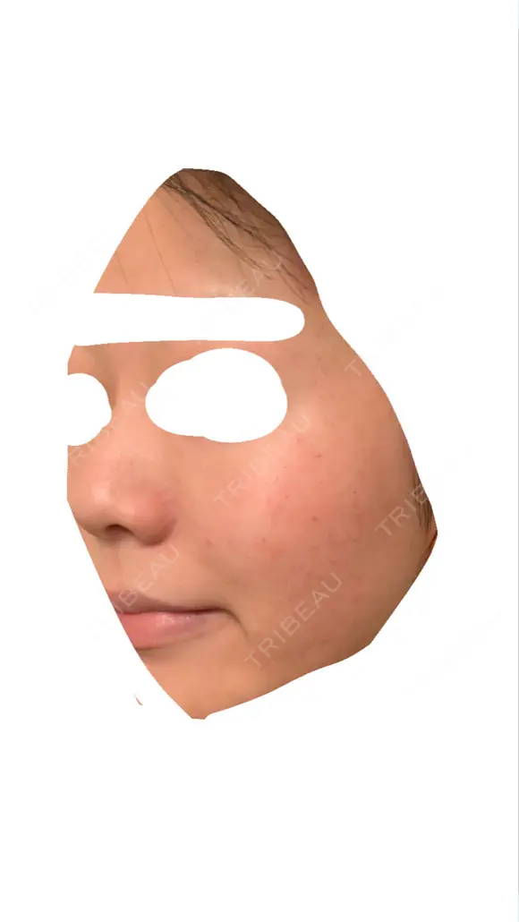 フラクショナルレーザー（毛穴・ニキビ跡） しらゆりメディカルクリニック （旧しらゆりビューティークリニック） DAY 6 メイン用