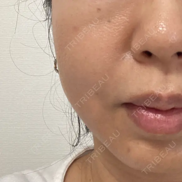 糸リフト BAO CLINIC 梅田院 AFTER メイン用