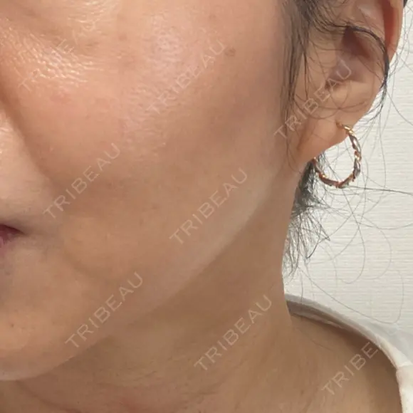 糸リフト BAO CLINIC 梅田院 DAY 11 メイン用