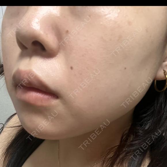 エレクトロポレーション / ルメッカ B-LINE CLINIC 池袋院 AFTER メイン用