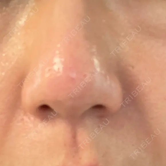 フラクショナルレーザー（毛穴・ニキビ跡） ガーデンクリニック 名古屋院 DAY 1 メイン用