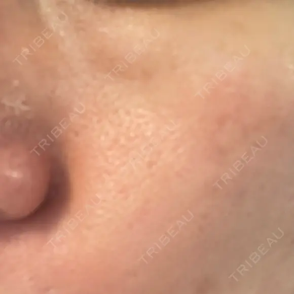 フラクショナルレーザー（毛穴・ニキビ跡） ガーデンクリニック 名古屋院 DAY 1 メイン用