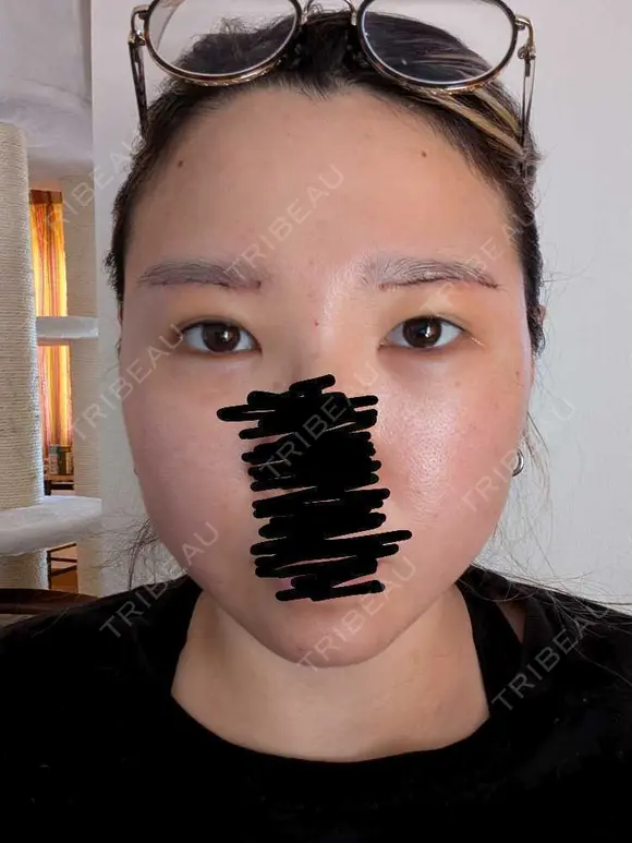 上まぶたたるみ取り / ダーマペン / 毛穴洗浄（ハイドラフェイシャルなど） Leap beauty clinic DAY 6 メイン用