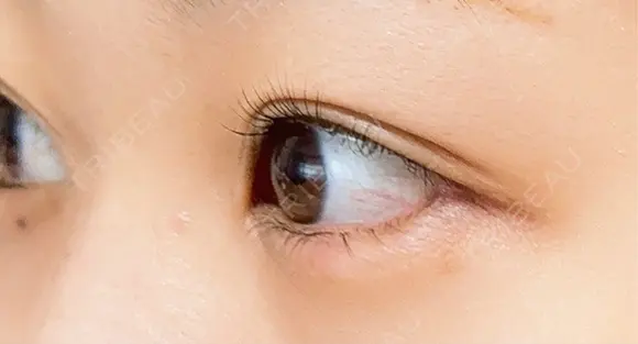 目尻切開 / タレ目形成・グラマラスライン（埋没） A CLINIC（エークリニック） 新宿院 DAY 13 メイン用