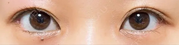 目尻切開 / タレ目形成・グラマラスライン（埋没） A CLINIC（エークリニック） 新宿院 DAY 13 メイン用