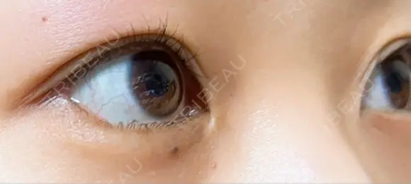 目尻切開 / タレ目形成・グラマラスライン（埋没） A CLINIC（エークリニック） 新宿院 DAY 13 メイン用