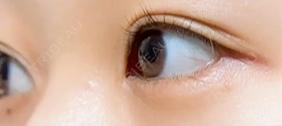 目尻切開 / タレ目形成・グラマラスライン（埋没） A CLINIC（エークリニック） 新宿院 DAY 13 メイン用